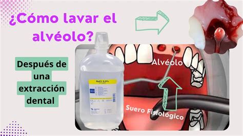 Cómo Lavar Y Limpiar El Alvéolo Dental Después De Una Extracción Dental Revisión 🦷 Clase 6