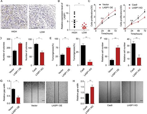 Lasp1 Expression Facilitated Tumor Growth And Invasion In Glioma A