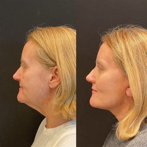 Facelift And Neck Lift Austin Tx Dr Weinfeld