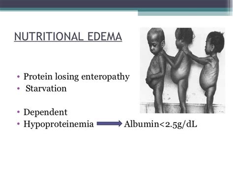 Clinical Features Of Edema