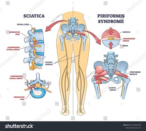 Sciatica Vs Piriformis Medical Muscle Conditions Royalty Free Stock