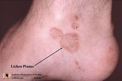 LichenPlanus4Samlaska - Academic Dermatology of Nevada