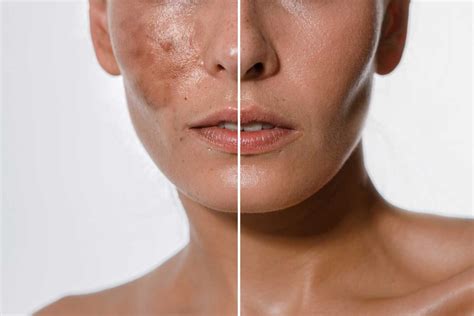 How To Treat Melasma With Tri Luma Cream A Comprehensive Guide