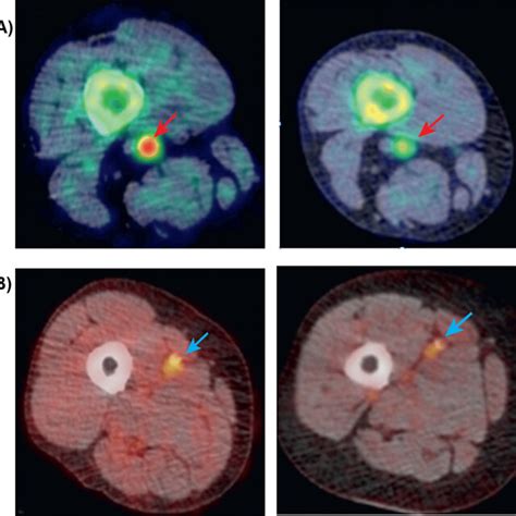 A 18F NaF PET CT Reveals Significant Uptake In The Superficial Femoral