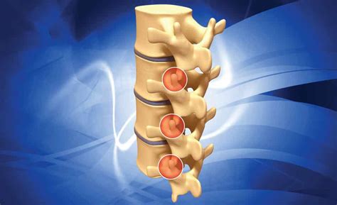 Facet Joint Dysfunction Walkley Chiropractic Group