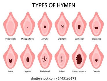 Types Hymens Medical Vector Illustration Stock Vector Royalty Free