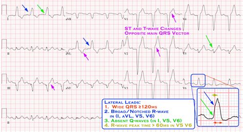 Bundle Branch Blocks Cardio Guide