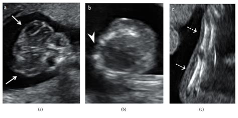 Prenatal Sonographic Image Of Sirenomelia With Anencephaly And