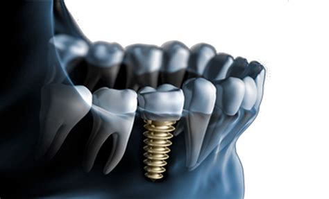 O que é um implante dentário quando e porquê optar por ele