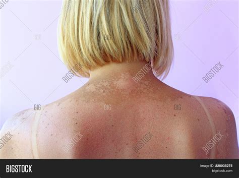 Sunburn Beach Sun Image And Photo Free Trial Bigstock