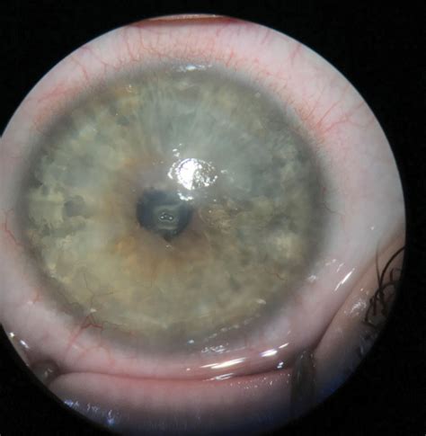 Transplantation For Limbal Stem Cell Deficiency