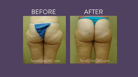 Vaser Liposuction Terrell Clinic In Oklahoma City