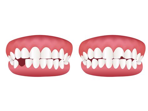 Bad Teeth Clip Art