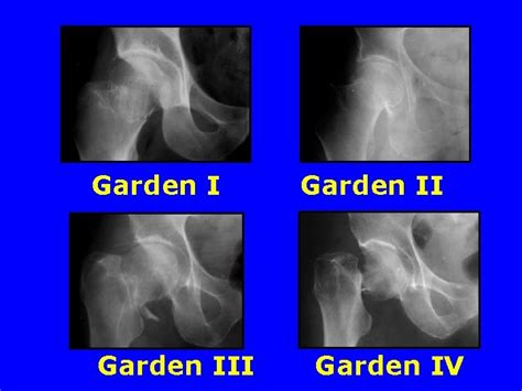 Fractures Du Col Hanche Normale Les Traves Osseuses