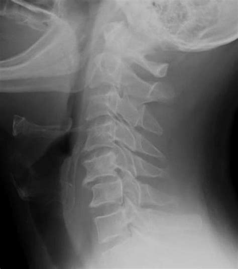 Bilateral Facet Dislocation