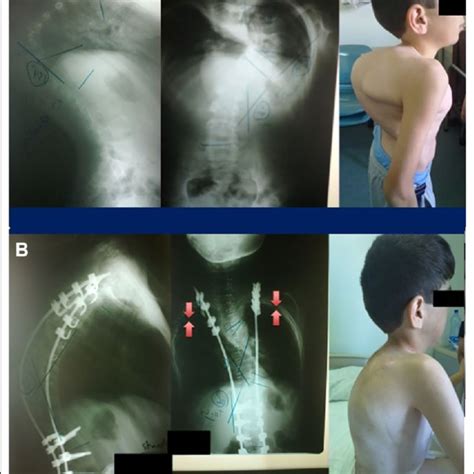 A And B Preoperative Anteroposterior And Lateral X Rays For