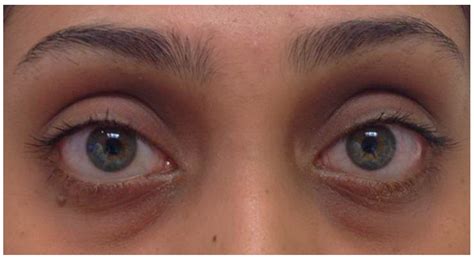 Graves Disease Eyes Treatment