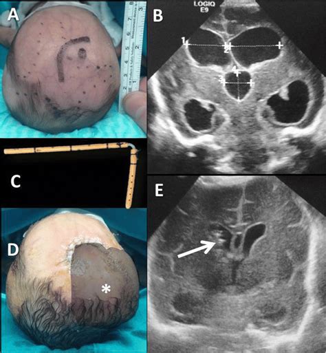 Preterm Baby With Large And Tense Anterior Fontanelle And Diastased