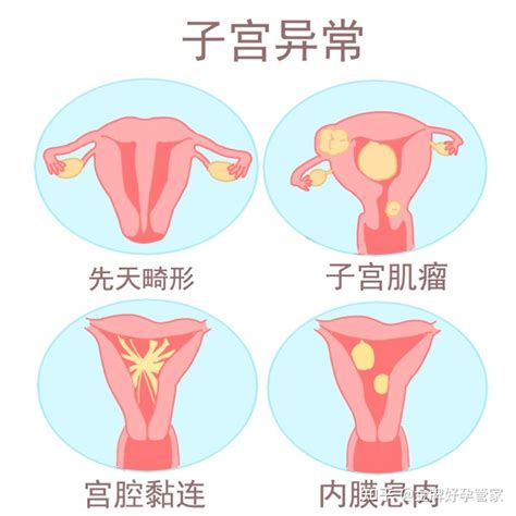 子宫畸形做试管婴儿成功率多少？主要看什么？ 知乎