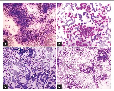 Figure 1 From Cytomorphological Features Of Medullary Thyroid Carcinoma