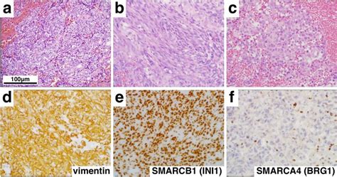 Histological And Immunohistochemical Findings Hematoxylin And