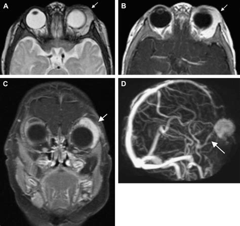 Hemangiomas And Vascular Malformations Of The Head And Neck A Simplified Approach Radiology Key