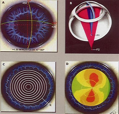 Topografía Corneal TOMEY Instituto Oftalmológico Hoyos