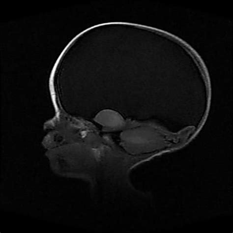 Hydranencephaly Mri