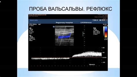 Дуплексное сканирование сосудов вен и артерий нижних конечностей что