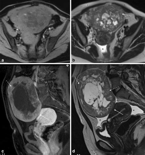 Cellular Fibroma Of The Right Ovary In A 50 Year Old Female Patient A