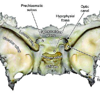 Sphenoid bone (extracted) -view from lateral. | Download Scientific Diagram