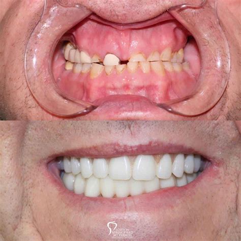 Hybrid Denture Smile Makeover - Dental Implant & Oral Surgery