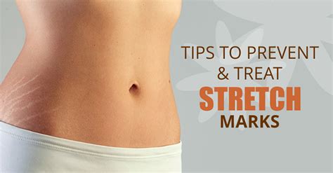 5 Key Ways To Both Treat And Prevent Stretch Marks