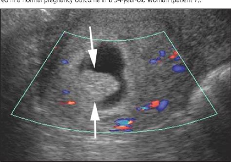 Figure 1 From The Chorionic Bump A First Trimester Pregnancy Sonographic Finding Associated