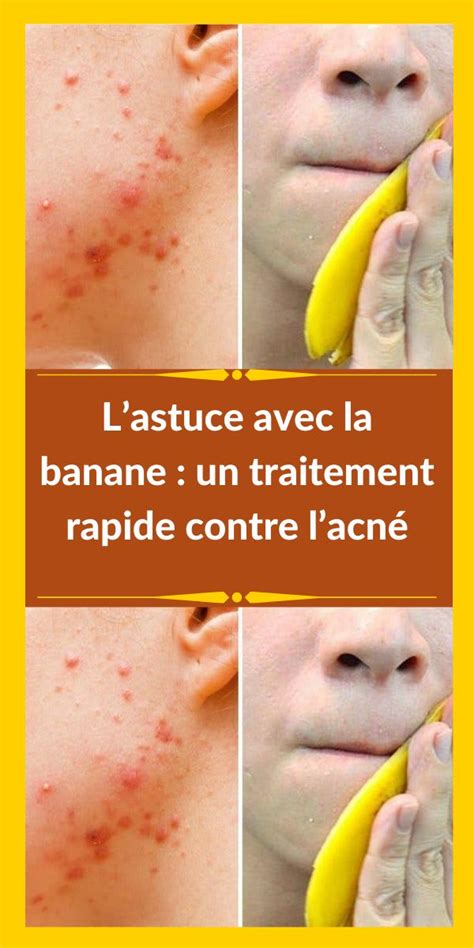 Lastuce avec la banane un traitement rapide contre lacné Acné