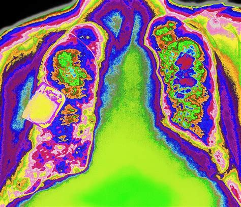 Coloured Chest X Ray Showing Heart Pacemaker Photograph By Mehau Kulyk