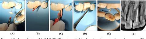 Figure 4 From Evaluation Of Root Canal Treatment In Chronic Periapical Abscess Of Central