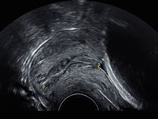 Chographie Du Premier Trimestre Avec Mesure De La Clart Nucale