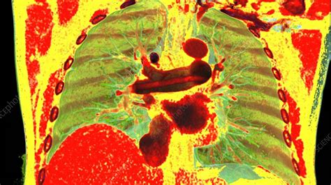 Pulmonary Embolism 3d Ct Scan Stock Video Clip K0103691 Science Photo Library