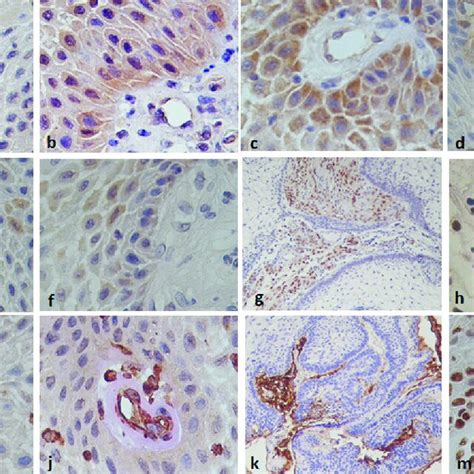 Immunohistochemistry A Ck Positive Immunoreaction In Squamous