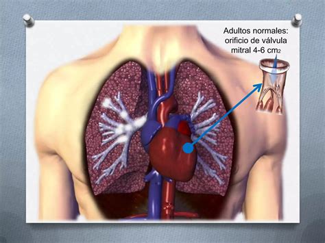 Estenosis Mitral PPT Descarga Gratuita