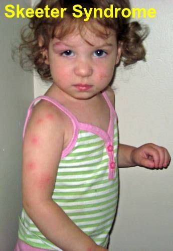 How To Deal With Skeeter Syndrome Mosquito Bite Allergy Kids