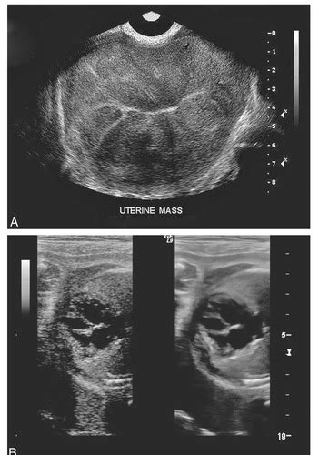 Ultrasound Artifacts Flashcards Quizlet