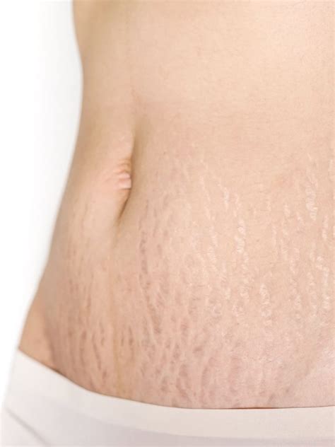 Stretch Marks Fresno Ca Behr Laser And Skin Care Center