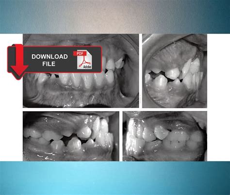 Anterior Crossbite Diagnosis And Orthopedic Treatment Odontovida