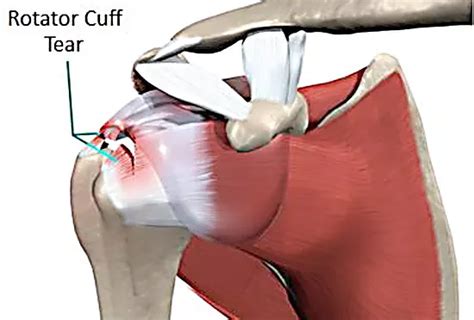 Rotator Cuff Tears Shoulder Doctor