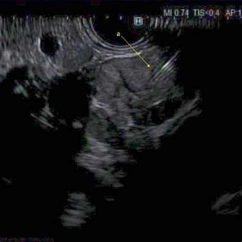 Hypoechoic Lesion Seen On Endoscopic Ultrasound Images Adjacent To The Download Scientific