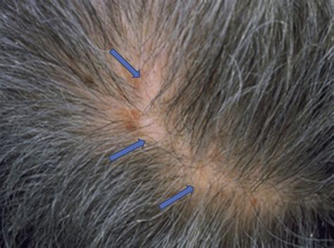 Focal Atrichia A Diagnostic Clue In Female Pattern Hair Loss Journal Of The American Academy