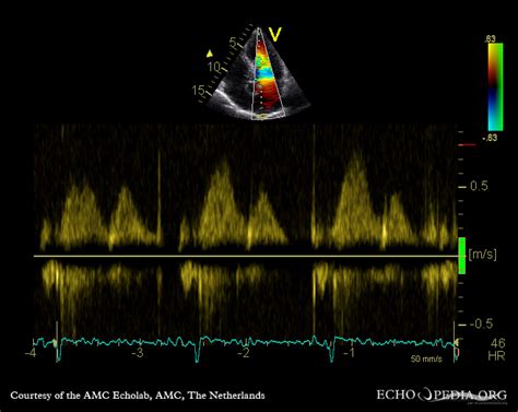 Pw Doppler Pulsed Wave Doppler Gepulster Doppler