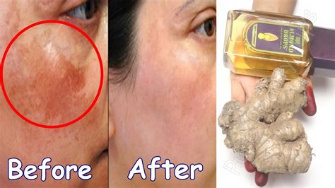 In 7 Days Remove Dark Spots Permanently Remove Dark Spots Black